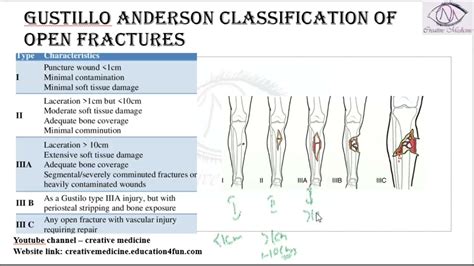 gusilo|Gustilo open fracture classification